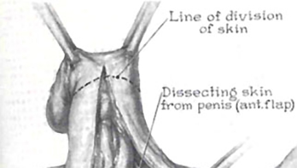 Hand drawn diagram of a Gender Reassignment Surgical Procedure